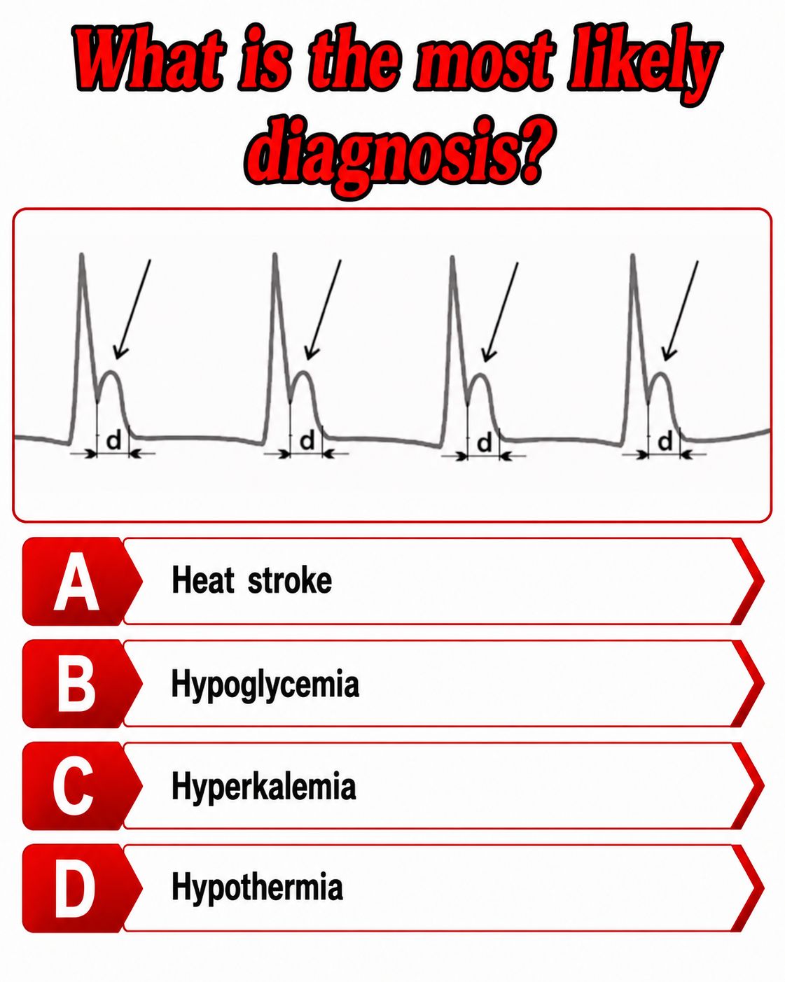 The J Wave (Osborn Wave): J wave, an extra deflection at the QRS