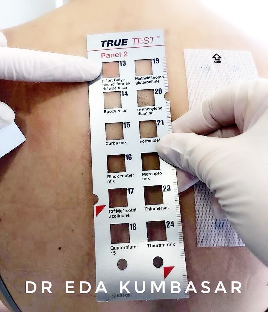 Ekzema hastalarina... - Dermatolog Dr. Eda Kumbasar