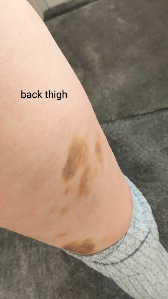 tirzepatide bruise Injection Site Bruising After Tirzepatide: Causes & Management Prevent Bruising from Tirzepatide Injections
