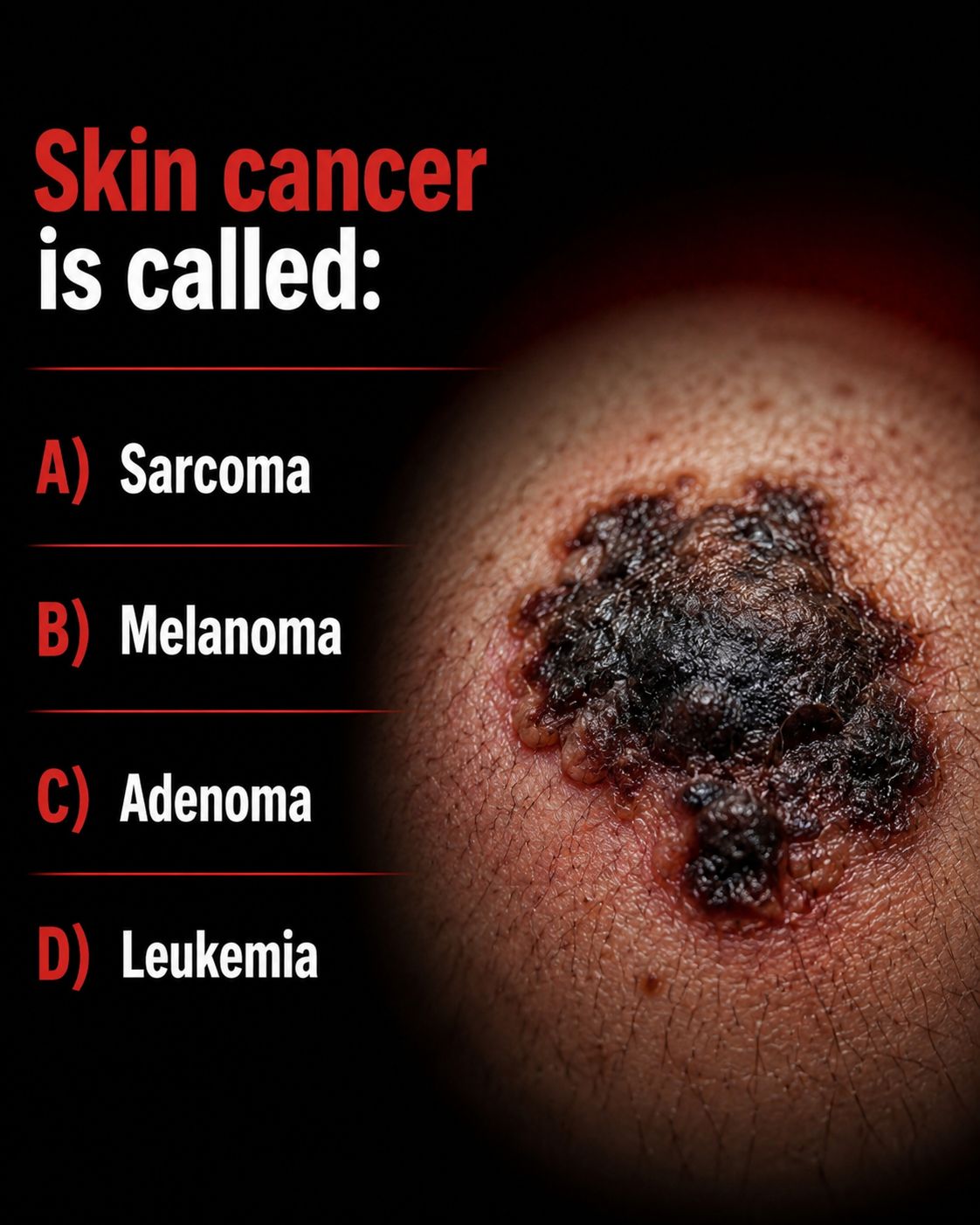 hutchinson melanotic freckle 12. Hutchinson's freckle. Which of the following is not correct?a) Mostly occurs in the elderlyb) Mainly occurs in covered parts of the body c) Malignant d) Irregular bordere) Irregular colo Pure Encapsulations Hong Kong
