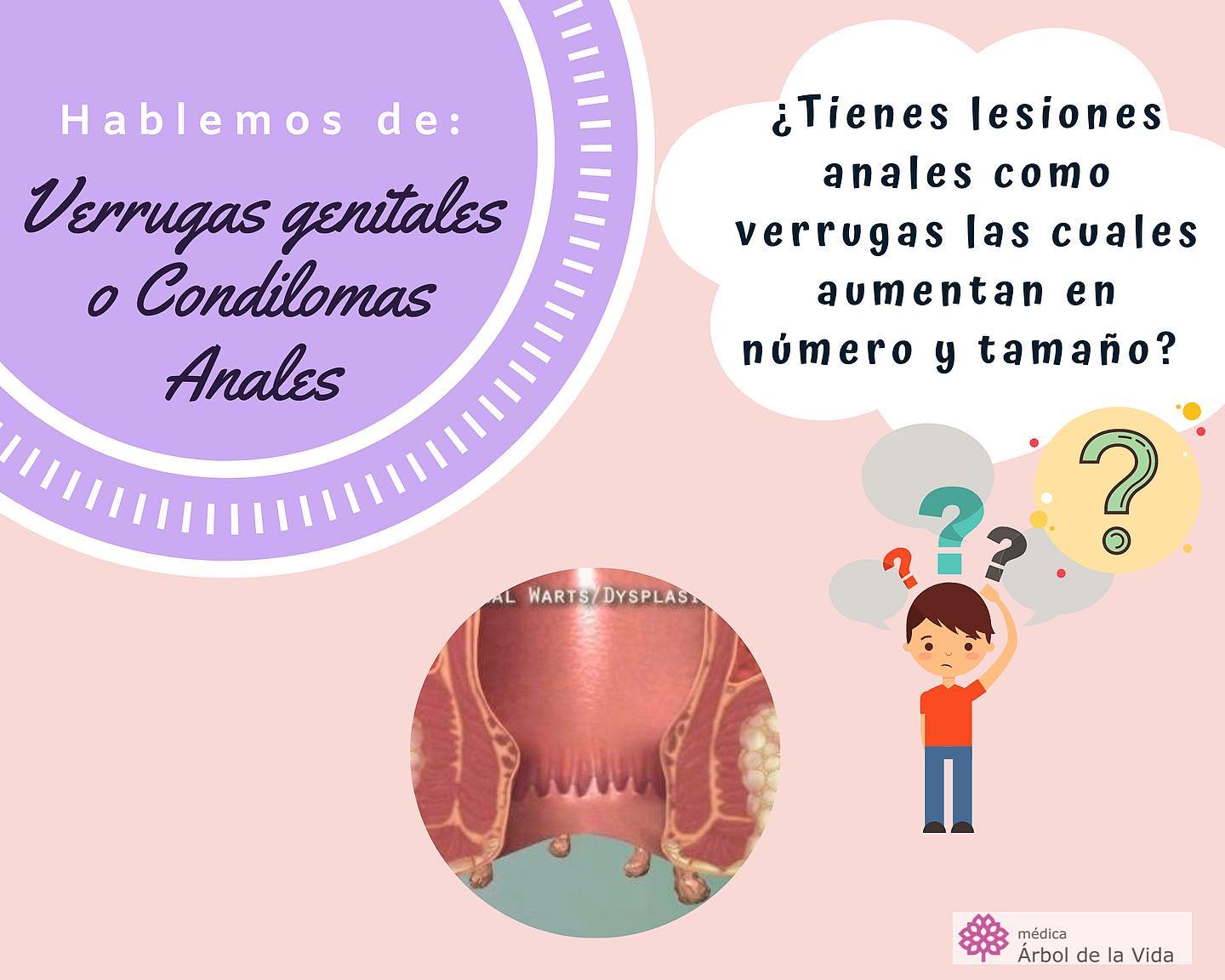 Coloproctología - Los condilomas, también conocidos como...