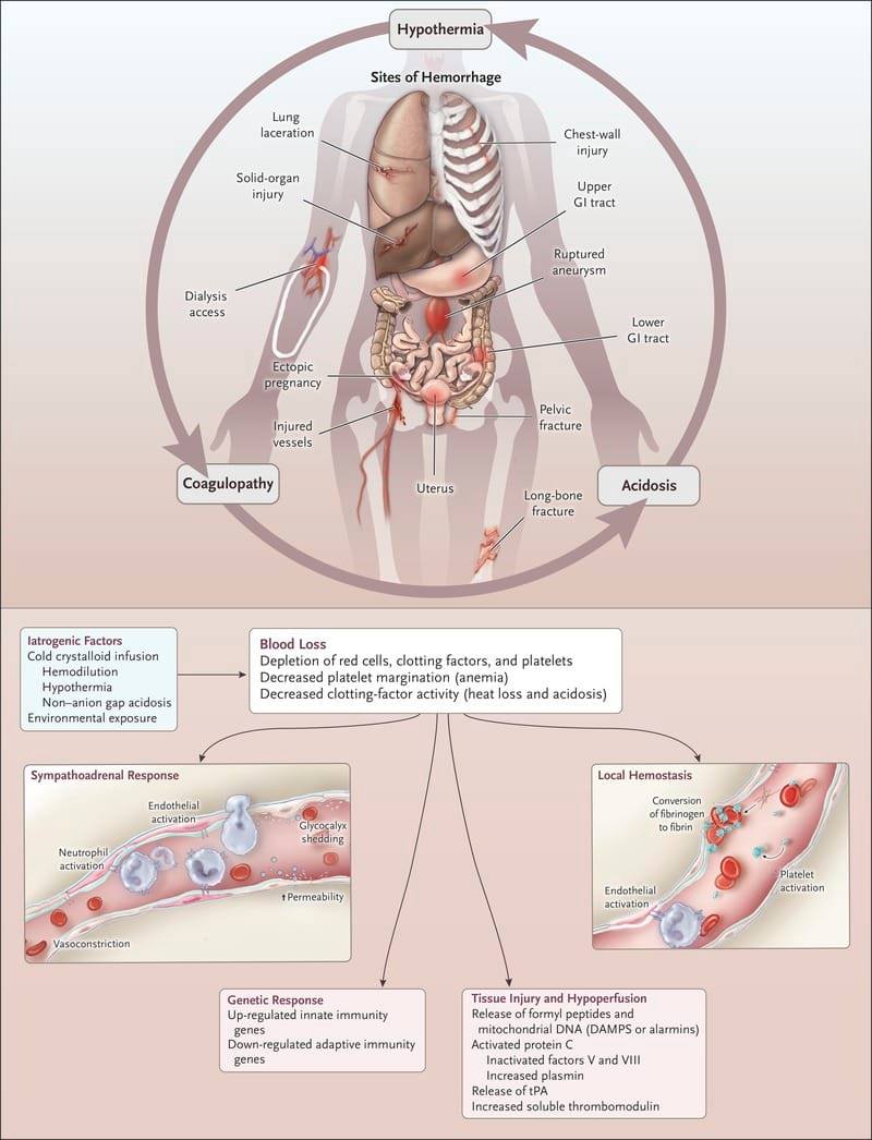 NEJM. The stages of hypovolemic shock. Hemorrhagic shock.. form of ...