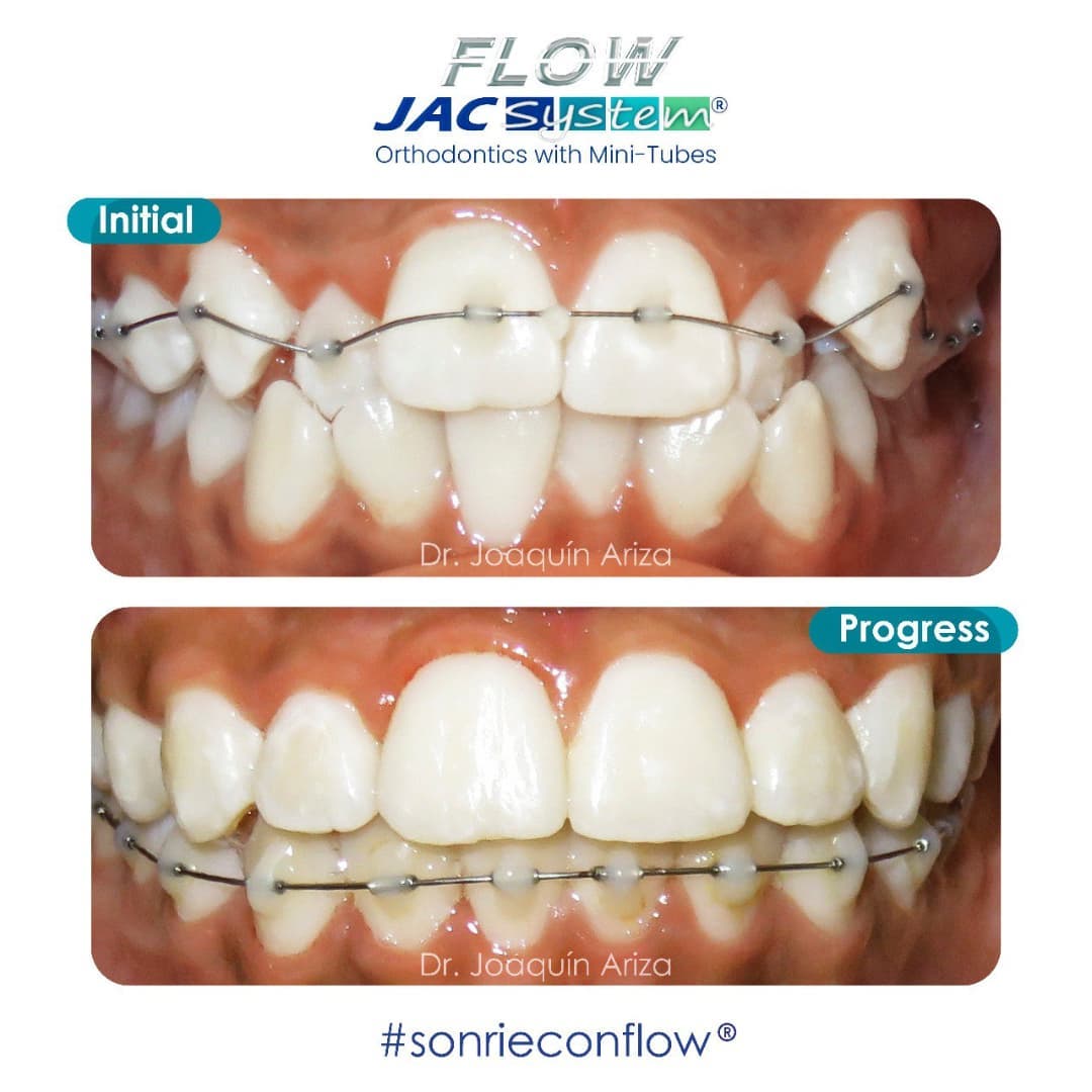 Flow Jac System - En Flow Jac, la posición sinérgica de...