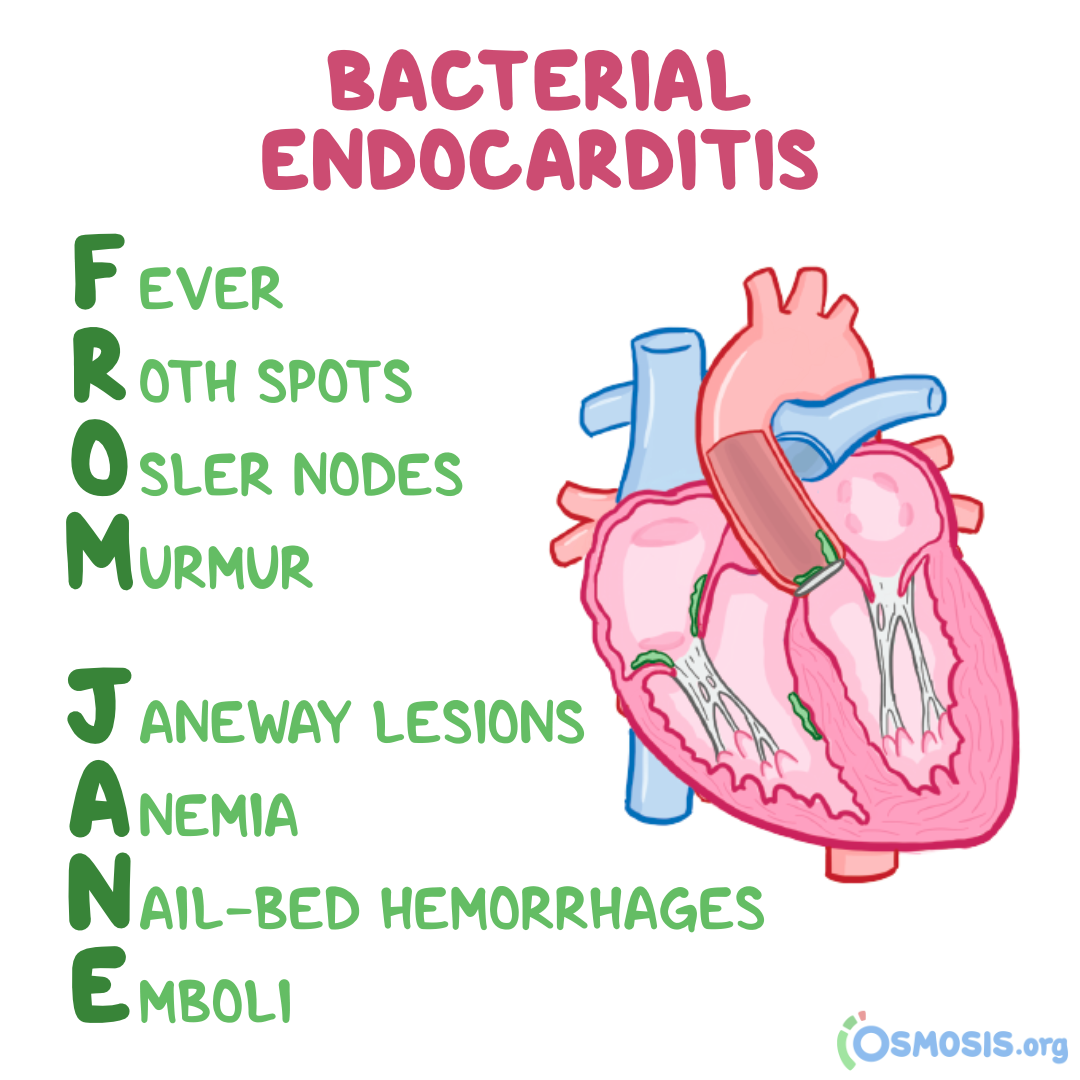 Infective Endocarditis Signs And Symptoms