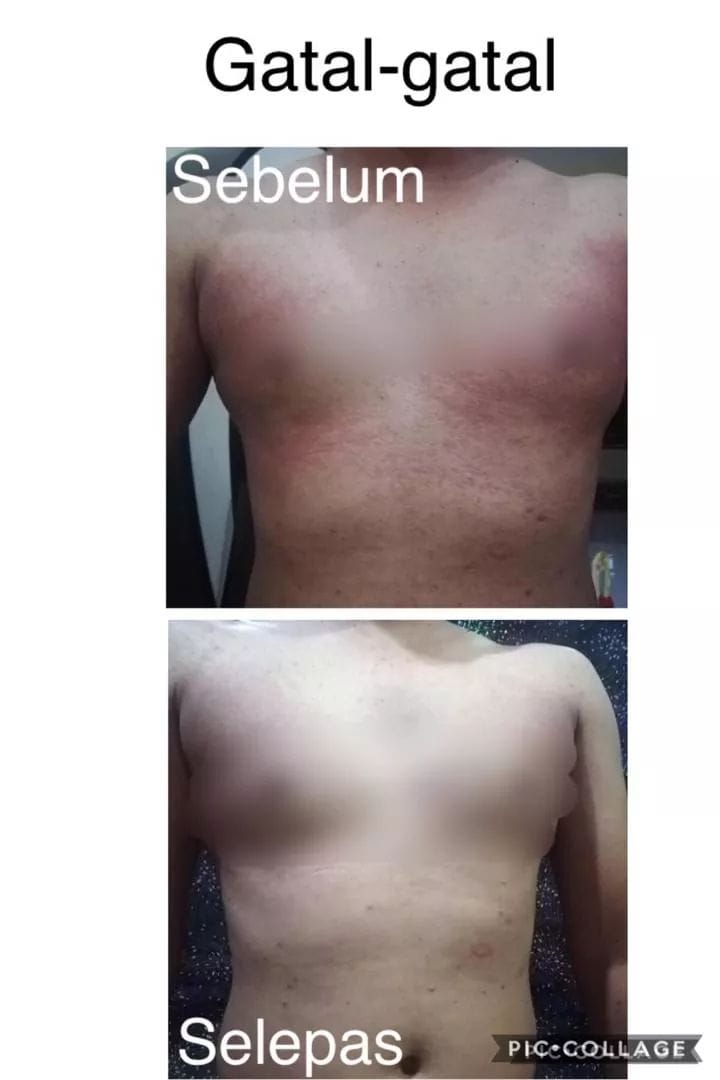 Testimoni Gatal Secara Tiba Tiba Aek Kupi Kuching Facebook