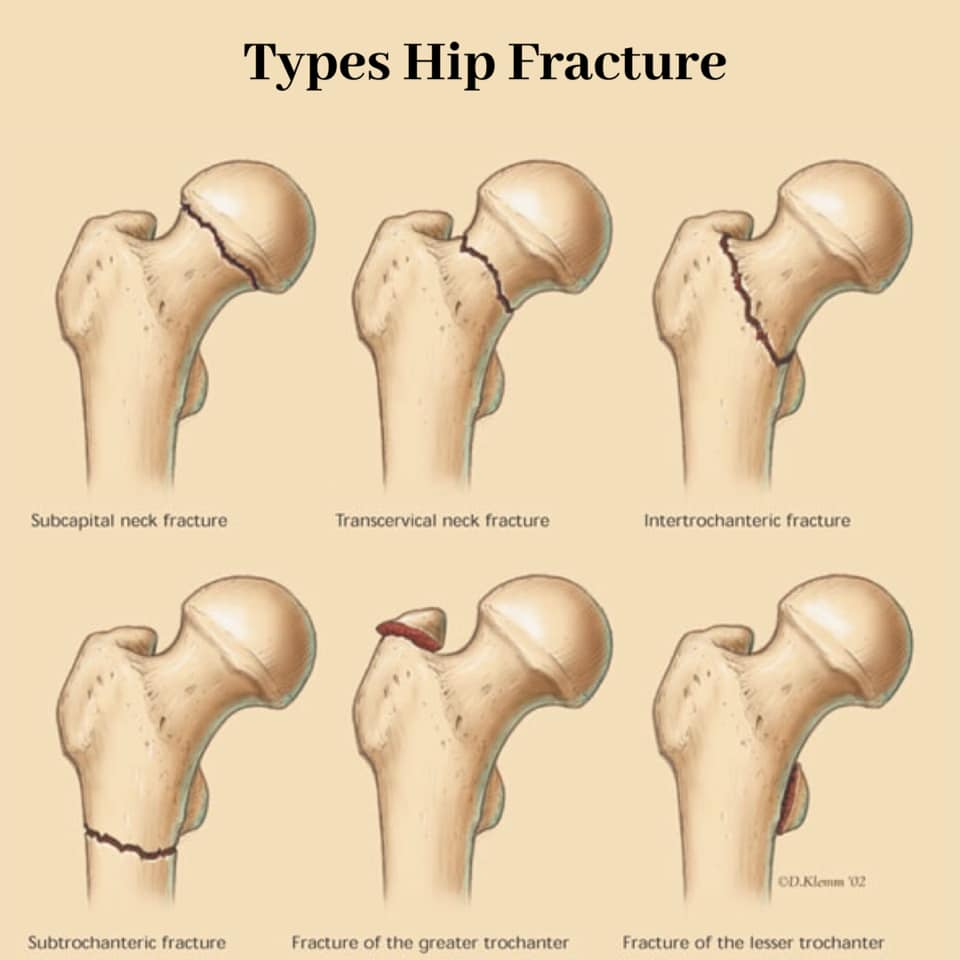 Hip Fracture Atau Retak Tulang Gold Physiotherapy Facebook