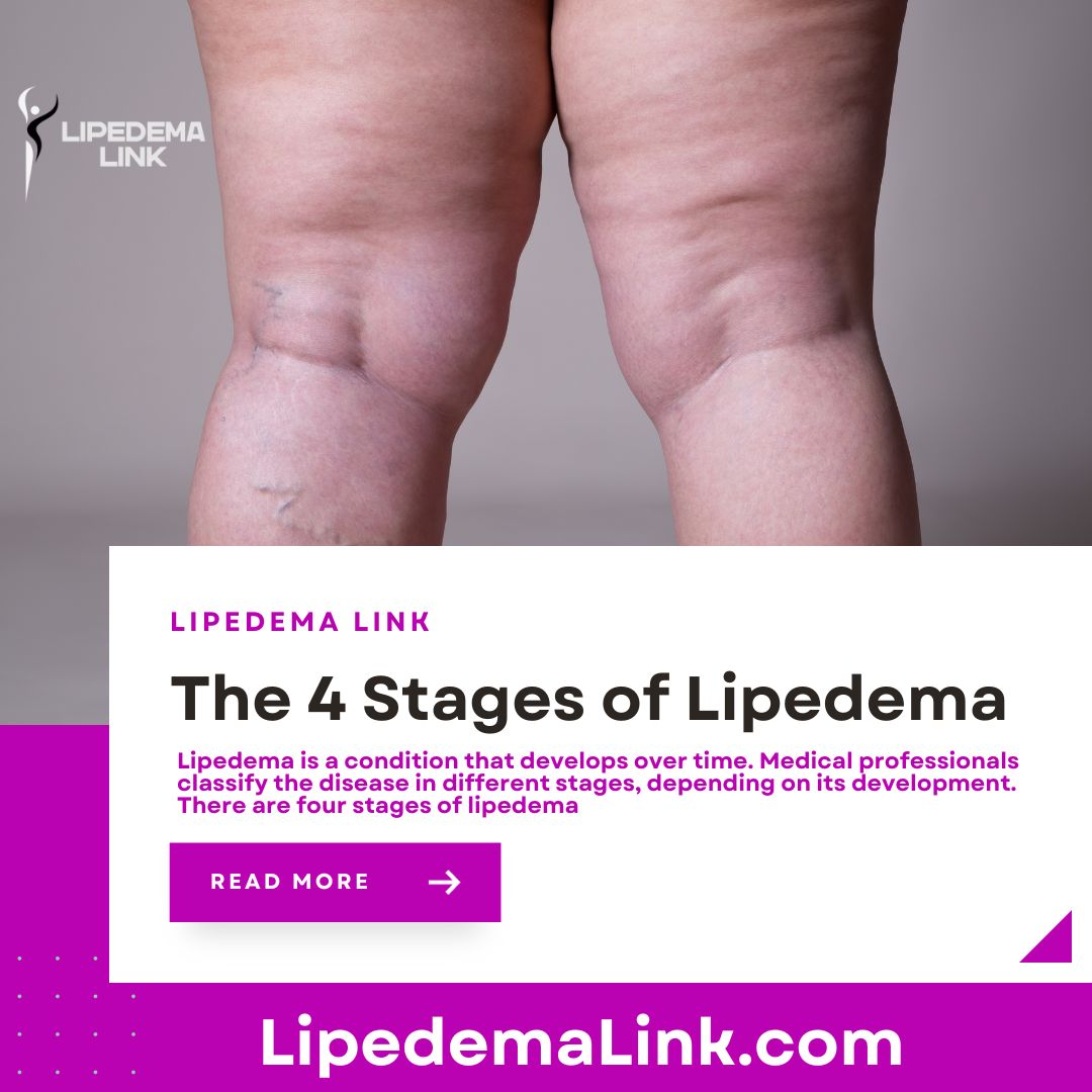 Lipedema - 🌟 Unveiling the Four Stages of Lipedema! 🦵 🔵 Stage 1: Skin ...