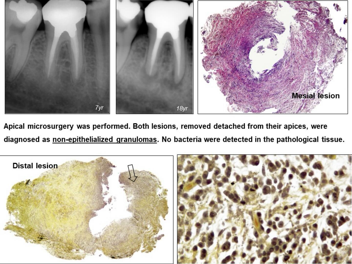 Recurring abscess after apicoectomy on canine tooth
