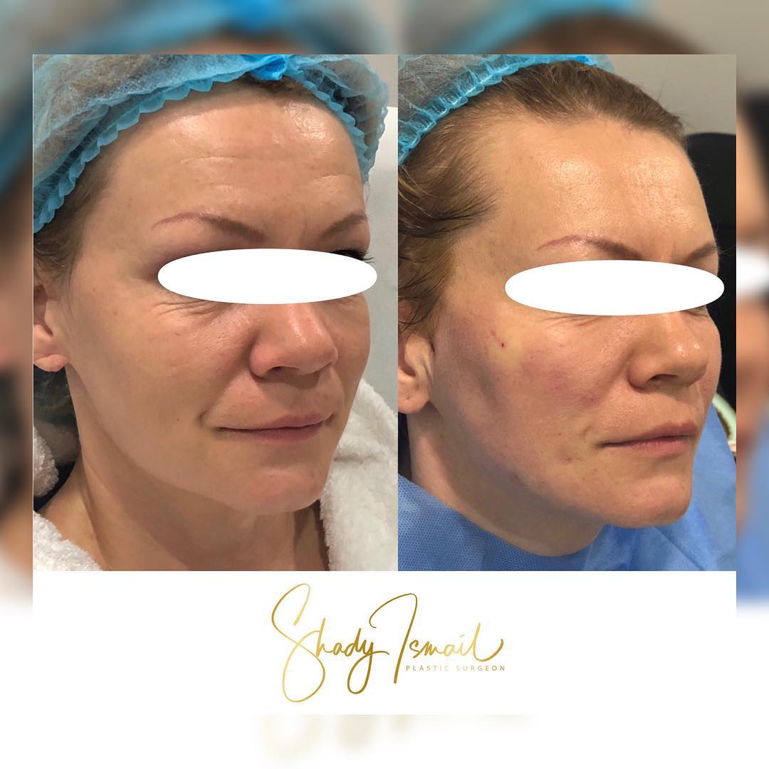 Dr Shady Ismail - A Thread Lift is an innovative facial...