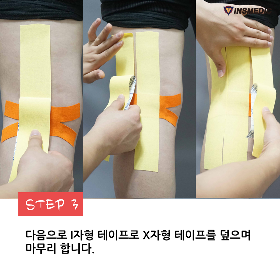 국제테이핑 - 무릎을 움직일 때 제일 중요한 무릎오금. 무릎오금 통증시에 도움되는 키네시오 테이핑... | Facebook