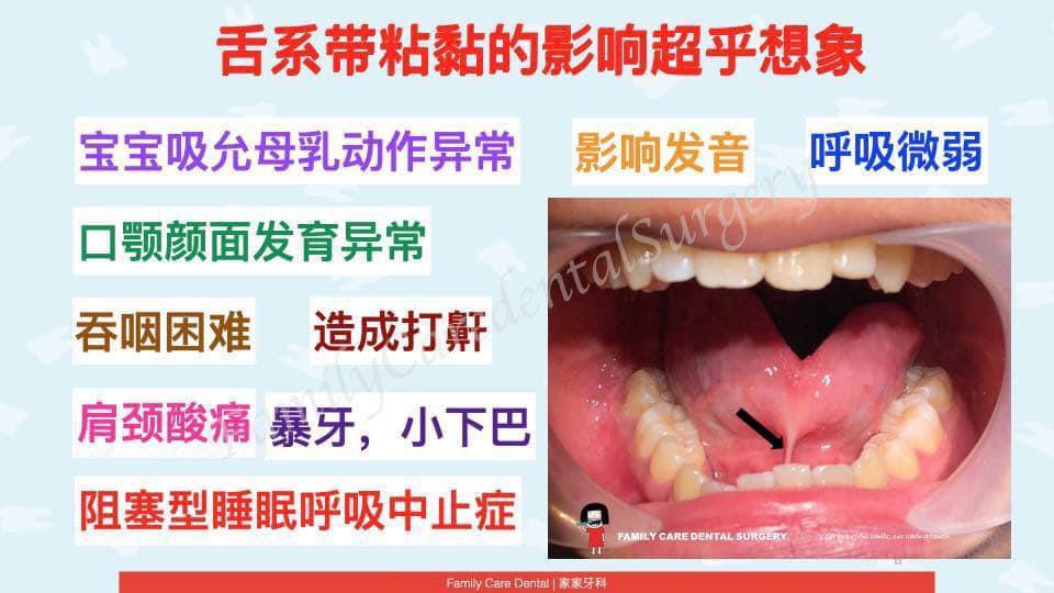 #什么是舌系带？它是干吗用的？... - 依虹 睡眠牙医师 Sleep Dentist Dr Chen