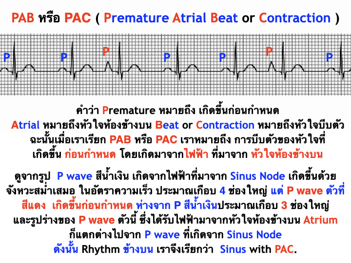 กลุ่มเพื่อนพยาบาล | **PAB หรือ PAC ( Premature Atrial Beat or ...