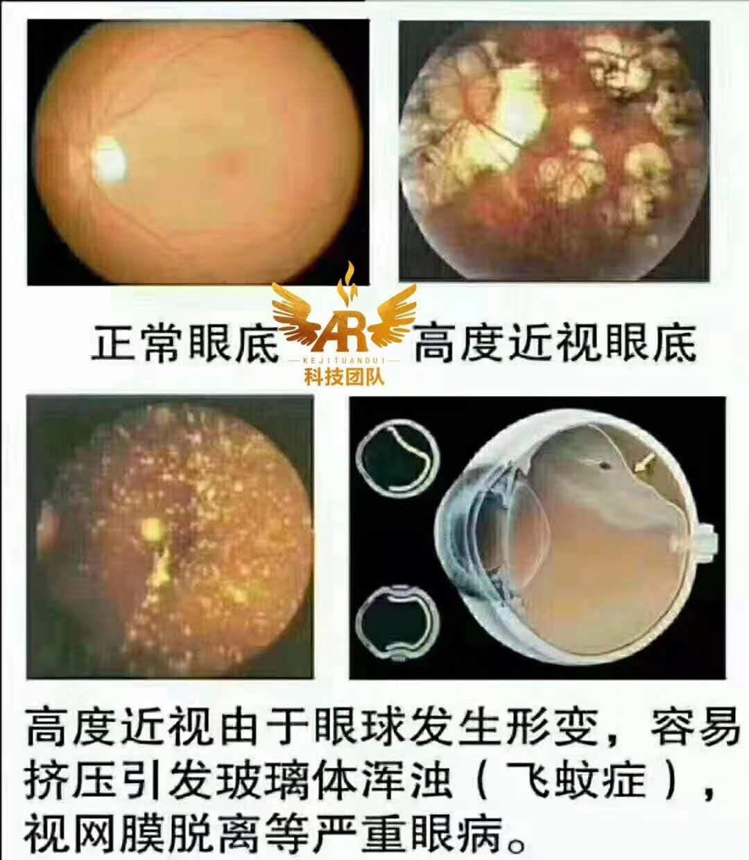 愛大愛手机眼鏡mobile Phone Eyeglasses 近视带来的影响 1 诱发多种病变 近视可导致玻璃体浑浊 巩膜视网膜变薄 周边视网膜变性 视网膜裂孔 视网膜剥离 脉络膜新生血管 青光眼 白内障 黄斑部退化 黄斑部出血等 Facebook