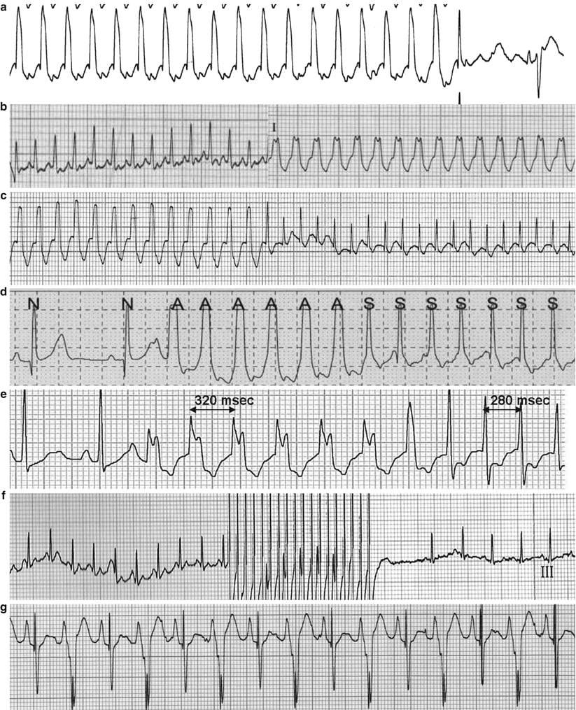 EKG Central - 🔰 Seven examples of SVT. 🔰 (A) AVRT... | Facebook