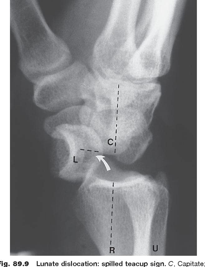 Lunate Dislocation Spilled Teacup