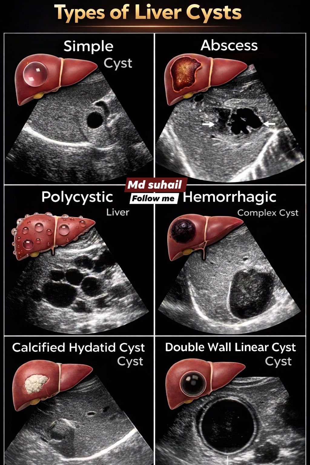 Md - Types of Liver Cysts – Ultrasound Based Identification 🤔💡🔍 # ...