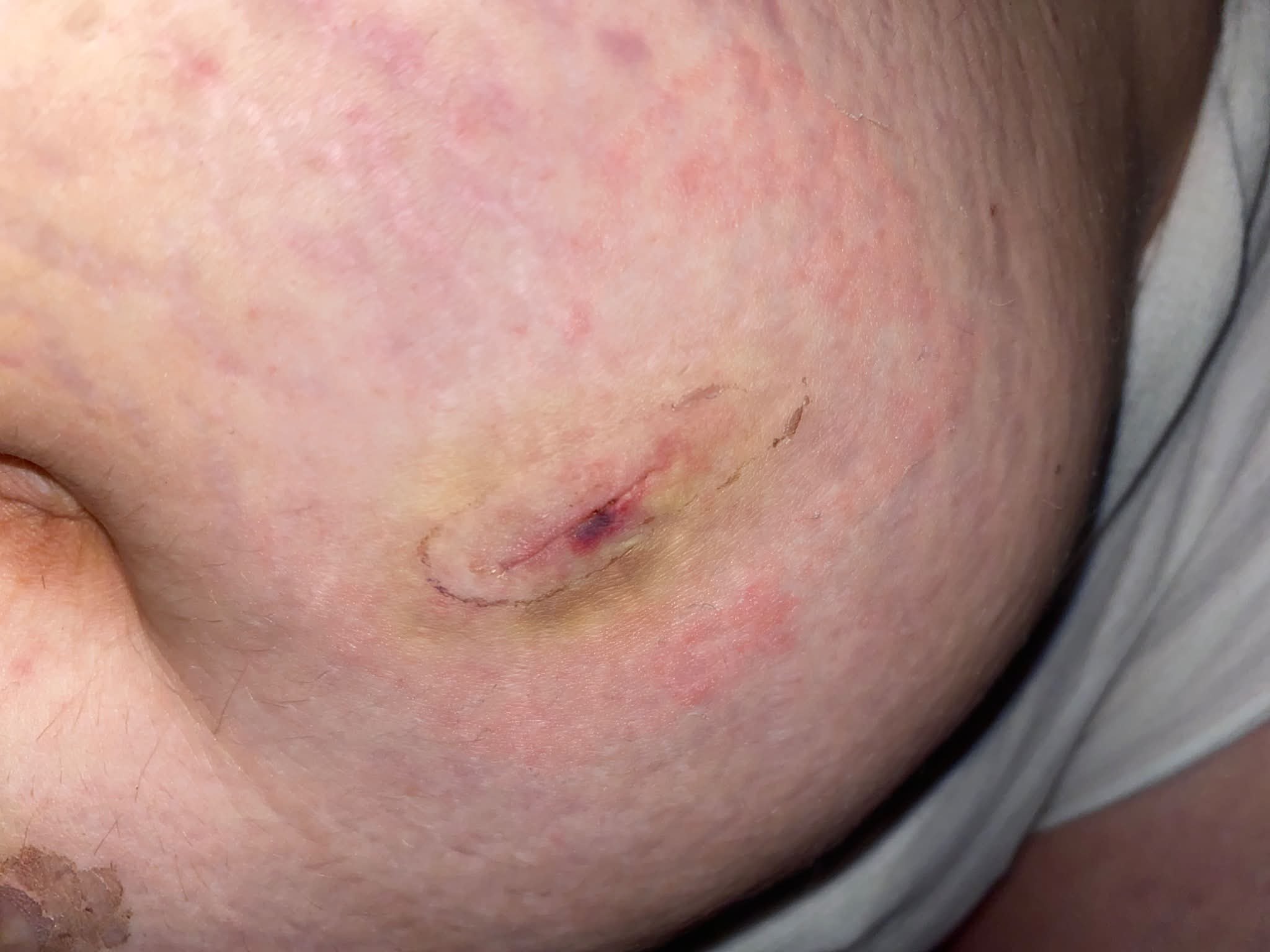 Anyone else start Tirzepatide back up a week post op gallbladder removal? My surgeon said go ahead, so far doesn't seem to be working like it was. Want to any know anyone's