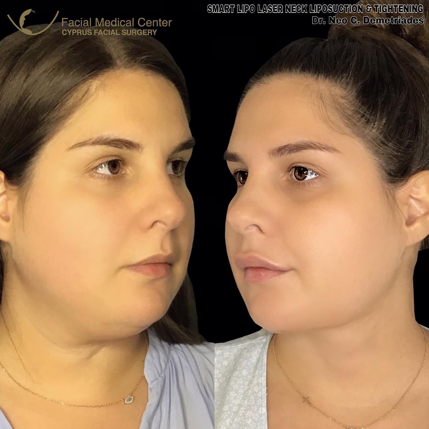 ‼️ SMART LIPO LASER NECK... - Cyprus Facial Surgery