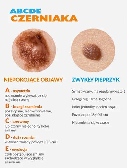 Nowotwory złośliwe skóry należą do najliczniejszej grupy złośliwych ...