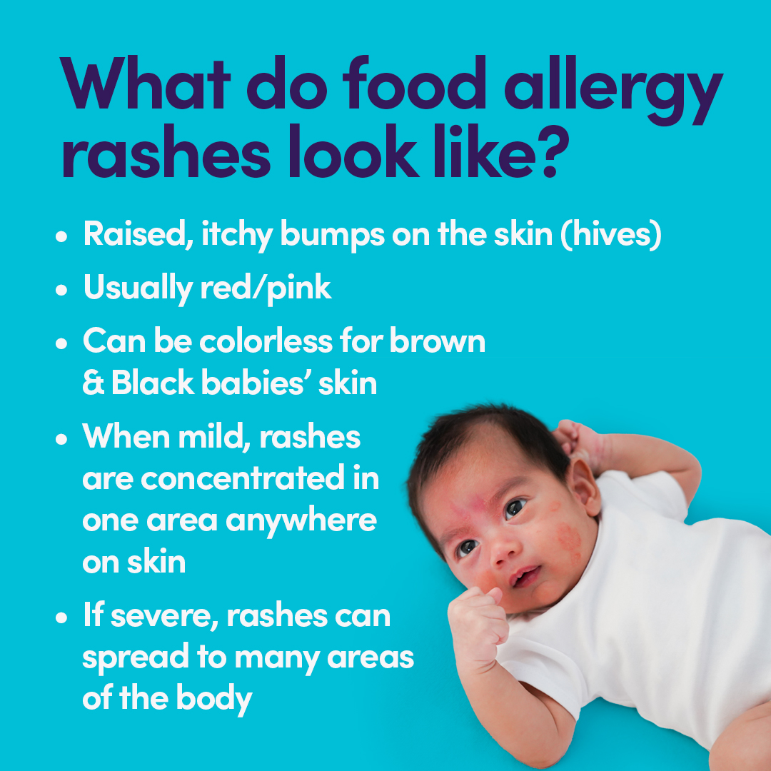 What is a food allergy rash, and what... - Ready, Set, Food