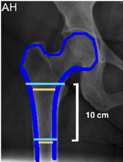 Dorr Classification The Dorr... - Orthopedic Trivia | Facebook