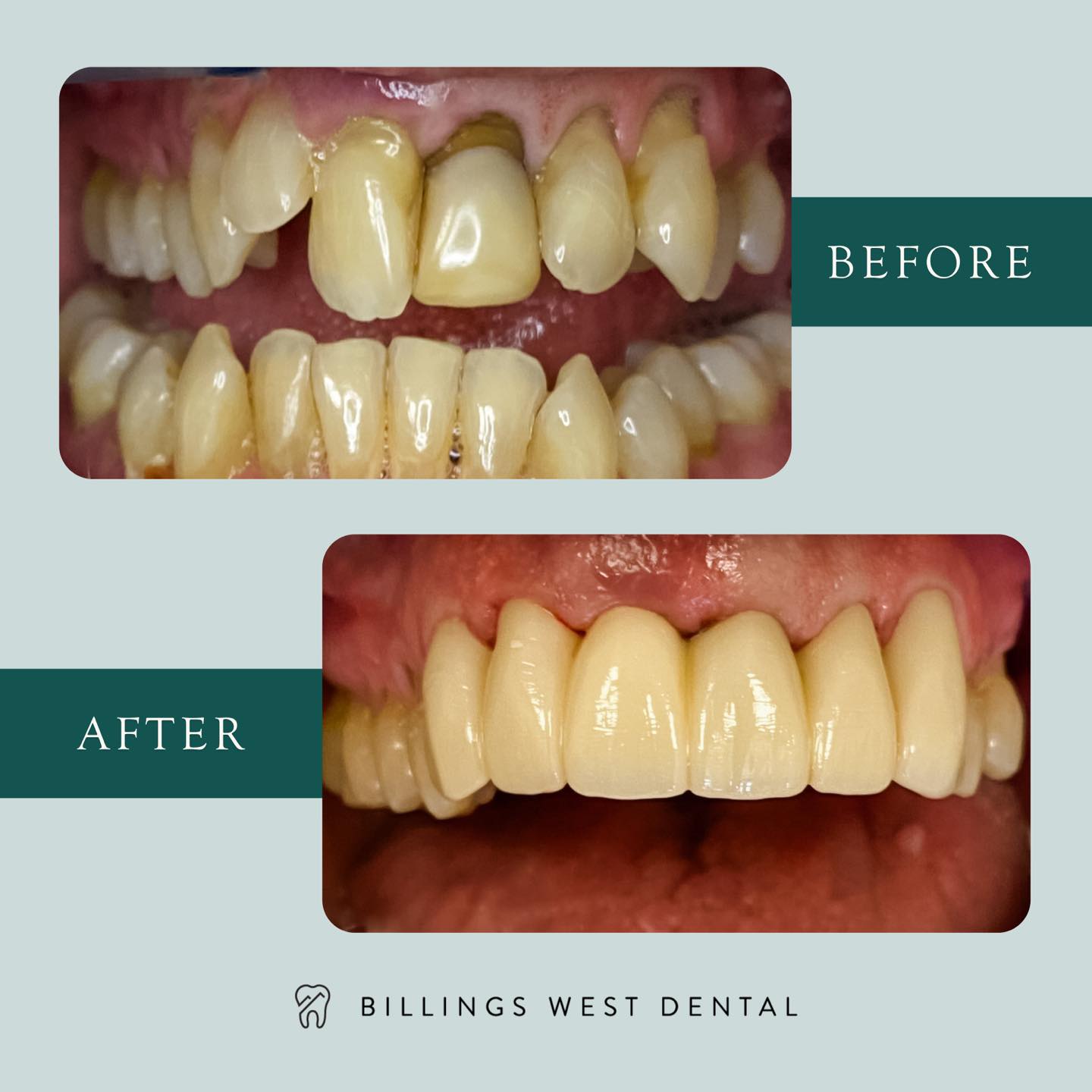 🤩 Before/after what was done… 🦷IN... - Billings West Dental