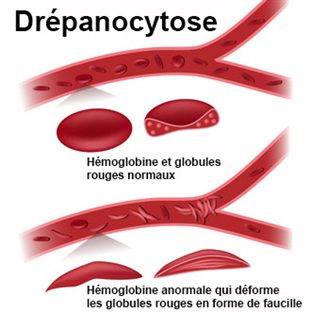 Médecine générale - Drépanocytose La drépanocytose, parfois appelée ...