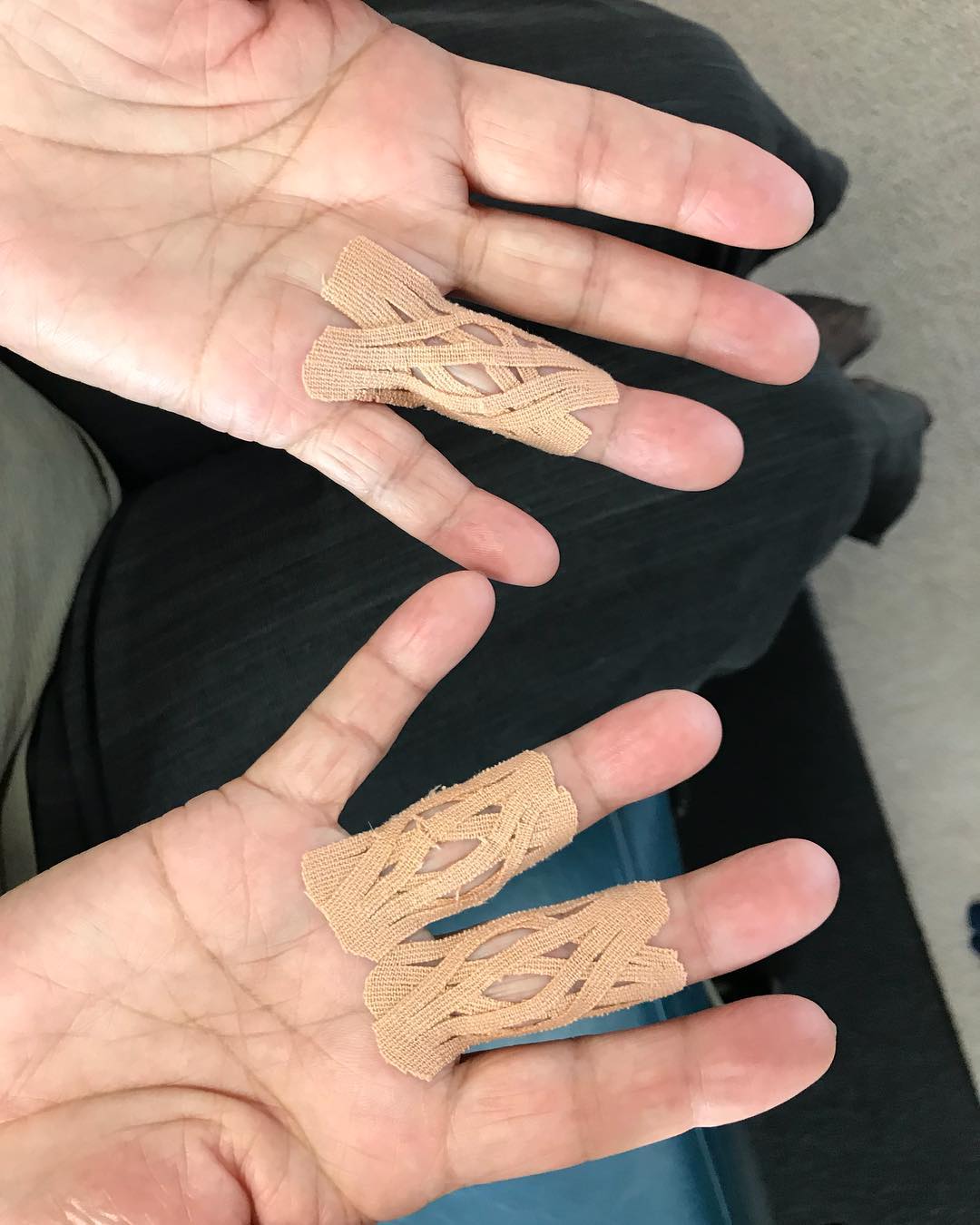 アールカイロプラクティックセンター バネ指に対するキネシオテーピング 指 を伸ばした時に痛み 皮膚が突っ張っていた所に網目状のedfテープを貼ると 少しだけ引っかかりが残るものの痛みは無くなり 指も自力でまっすぐ伸ばせるようになりました キネシオ