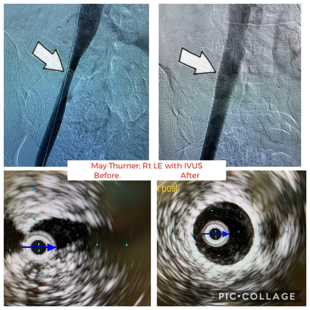 Ashchi - May-Thurner Syndrome, also known as Iliac Vein Compression ...