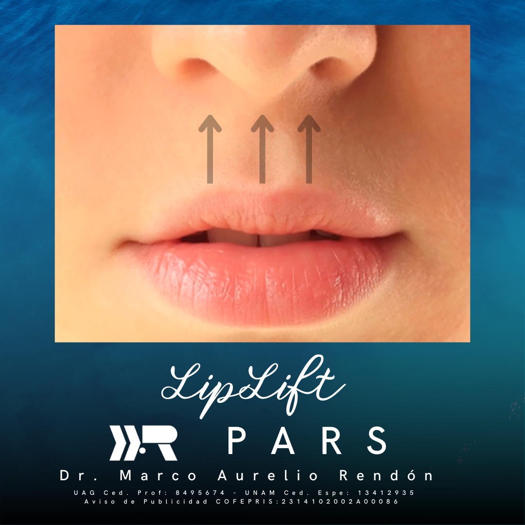 Dr. Marco Aurelio Rendón-Medina - El objetivo del lip-lift es acortar ...