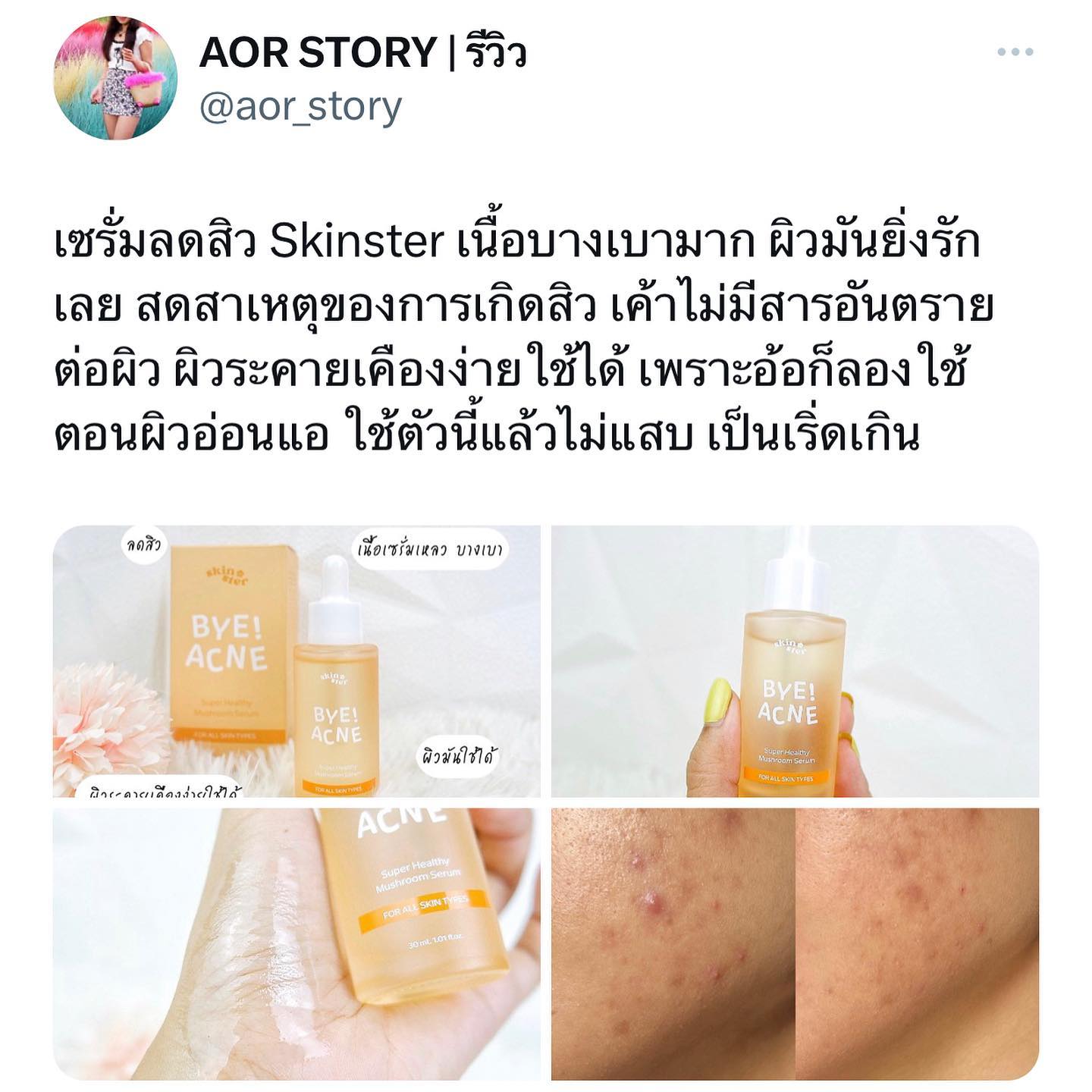 ขอบคุณรีวิวจากค... - Skinster สกินแคร์ลดสิว เหมาะกับทุกสภาพผิว