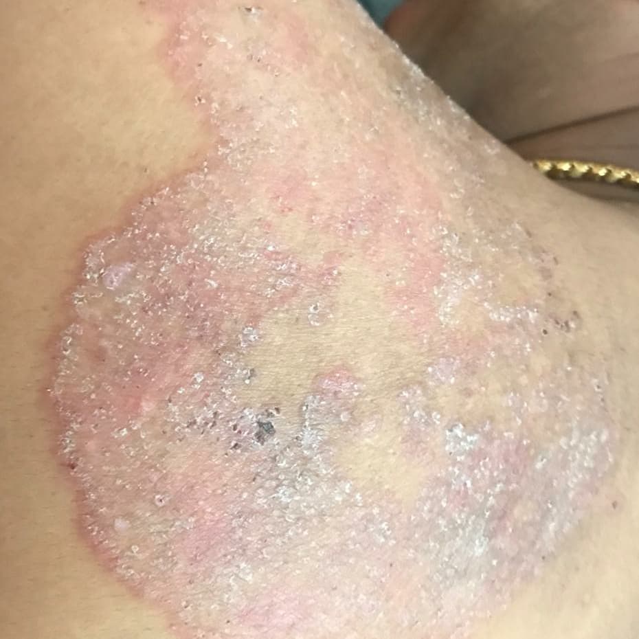 Tinea Corporis and Tinea Capitis... - dermatologyblogger | Facebook