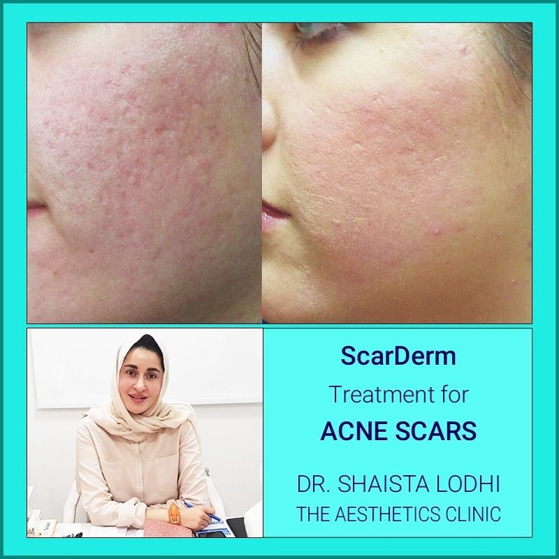 The Aesthetics Clinic - ScarDerm Treatment for Acne Scars. The ...