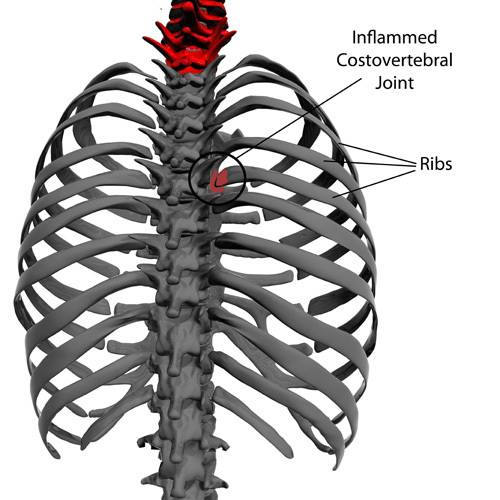 The signs and symptoms of Rib... - Tri Modern Health | Facebook