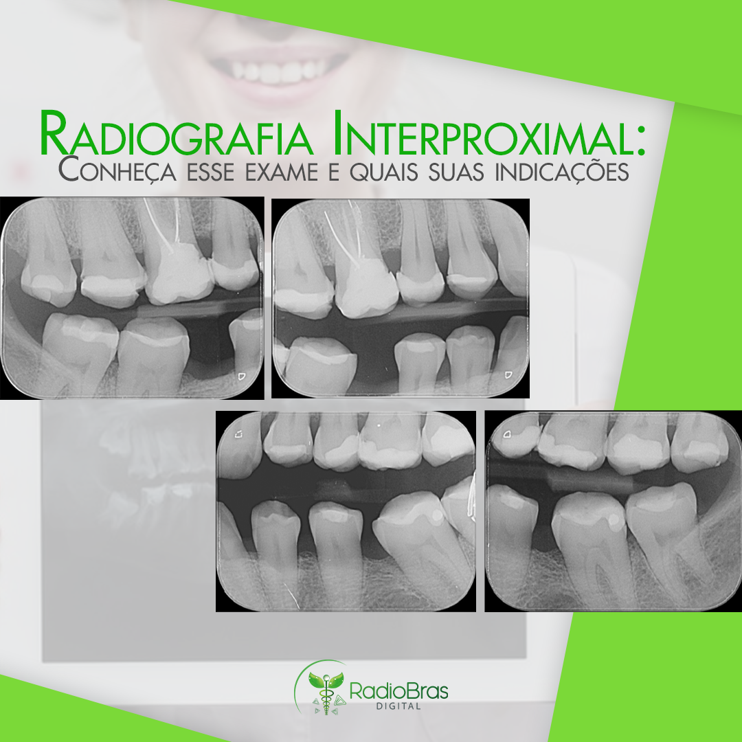 Radiobras - Radiografia Interproximal: Conheça esse exame e quais suas ...