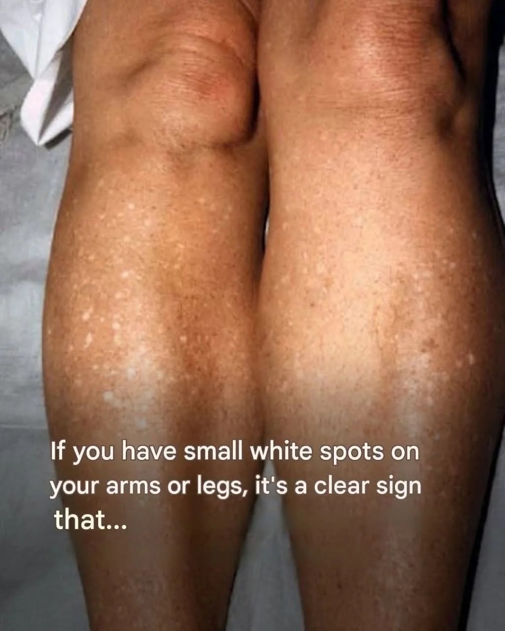 What are the small white spots on my arms after tanning and how to treat them?