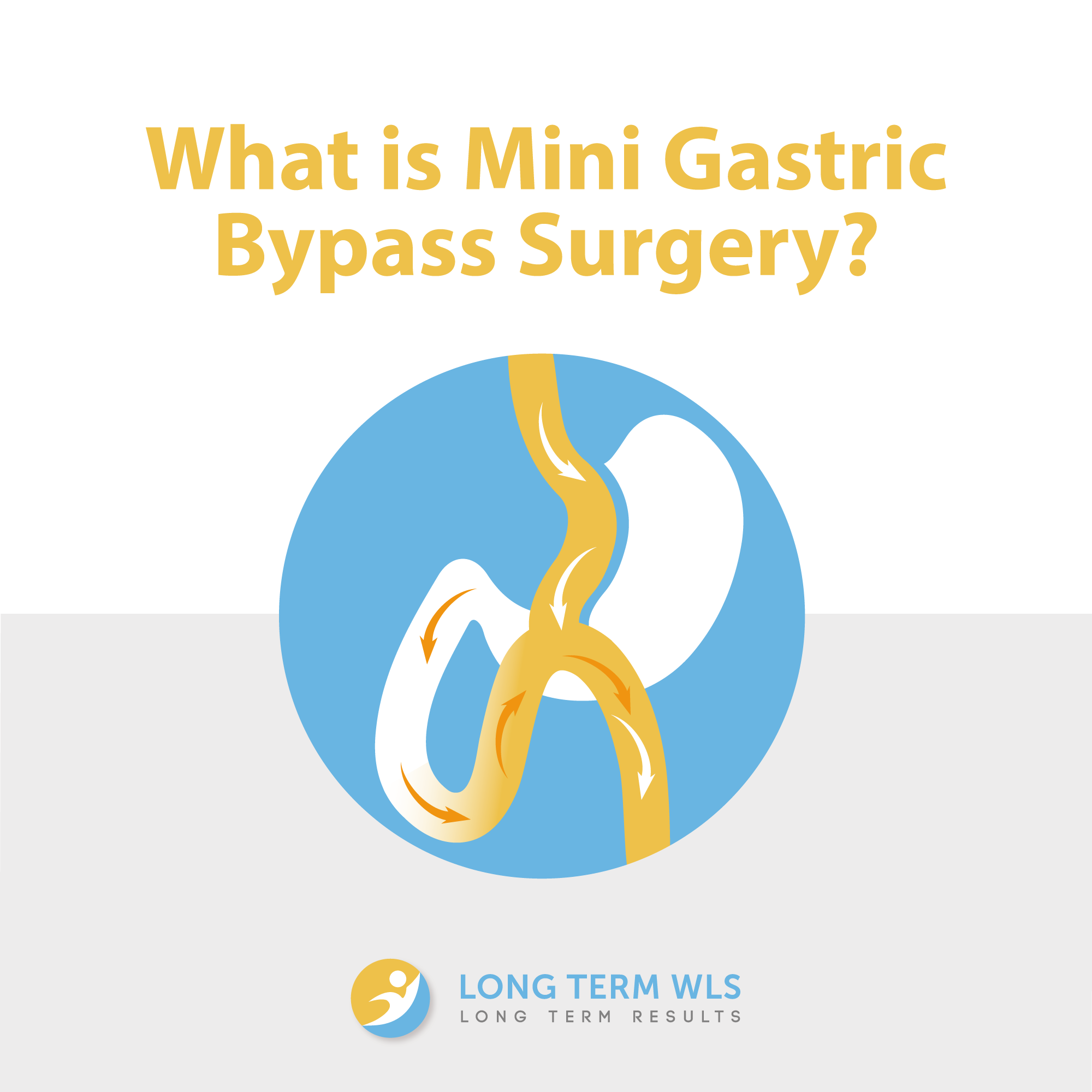 The Mini Gastric Bypass Surgery is a... - Long Term Medical | Facebook