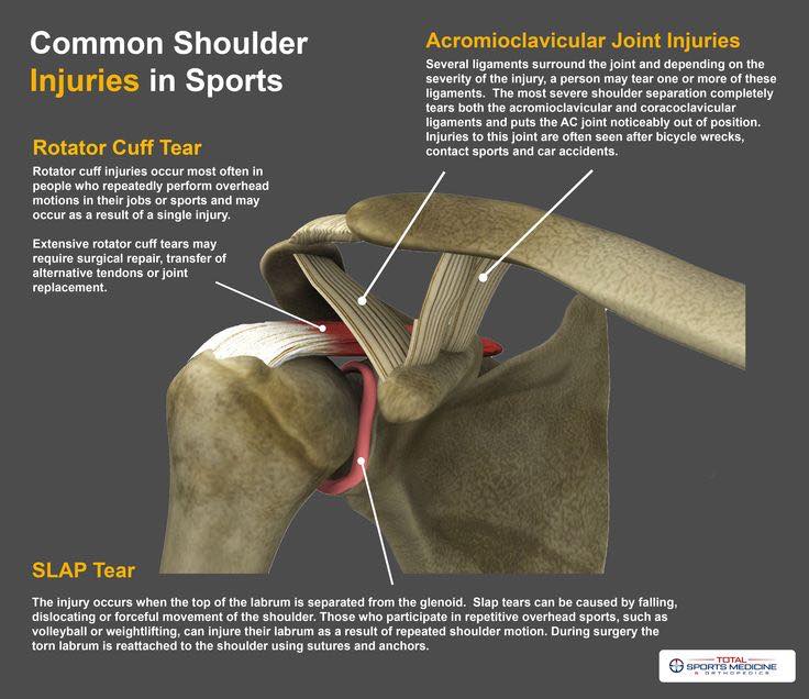Dr. Roddy McGee - What is a rotator cuff tear? When one or... | Facebook