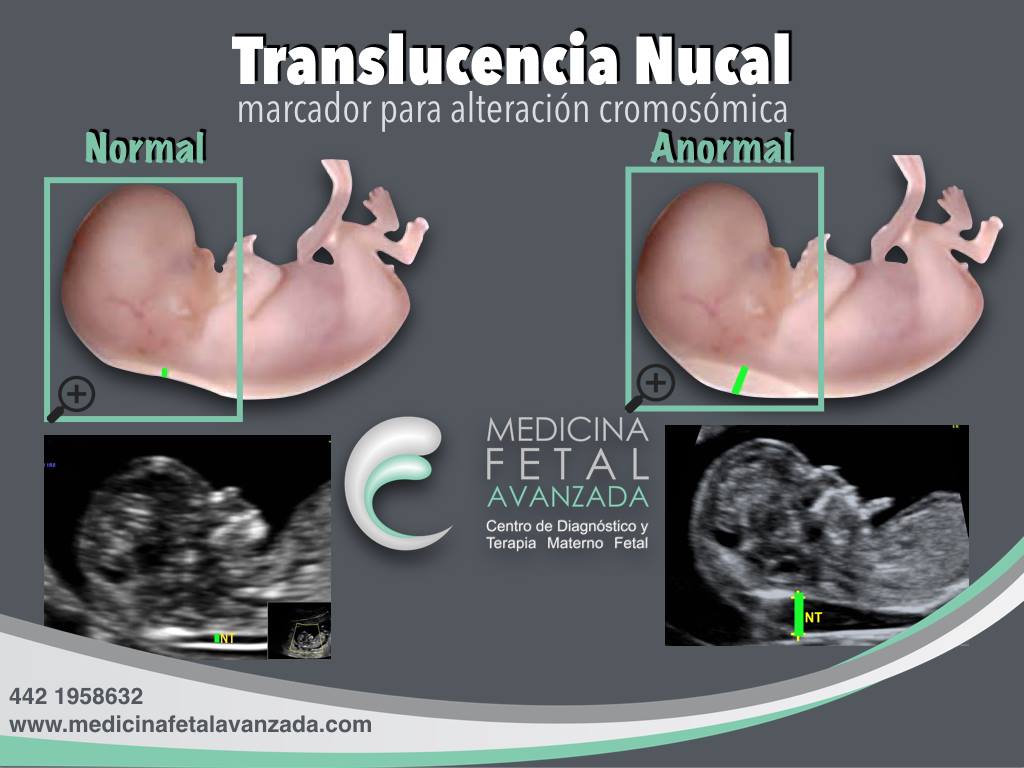 Medicina Fetal Avanzada - ¿¿¿QUE ES LA TRANSLUCENCIA NUCAL??? 1️⃣ ...
