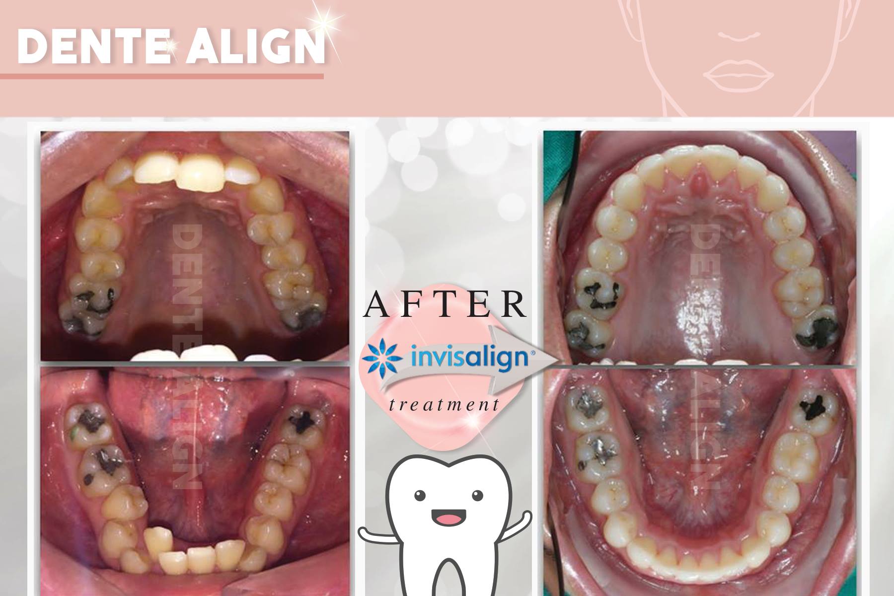 เสร็จเคส... - Dente Align Clinic - Invisalign Diamond Provider