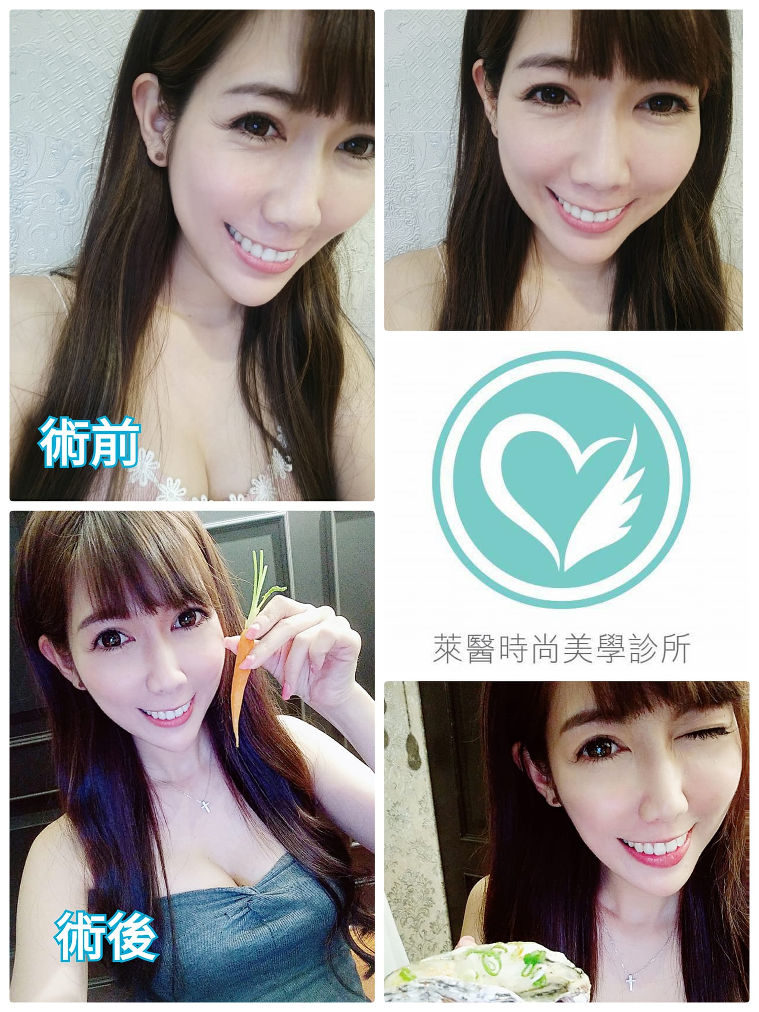 Smile Yun 小羊兒 每個愛美的女生背後都有很厲害的醫美診所醫生 因為我屬於乾性肌膚 所以從以前都特別在意細紋的問題 我去了 萊醫時尚美學診所 透過專業醫生的評估幫我施打了肉毒改善我的魚尾紋現在隨便拍照都好看終於可以盡情的大笑了 現在一週後 可以