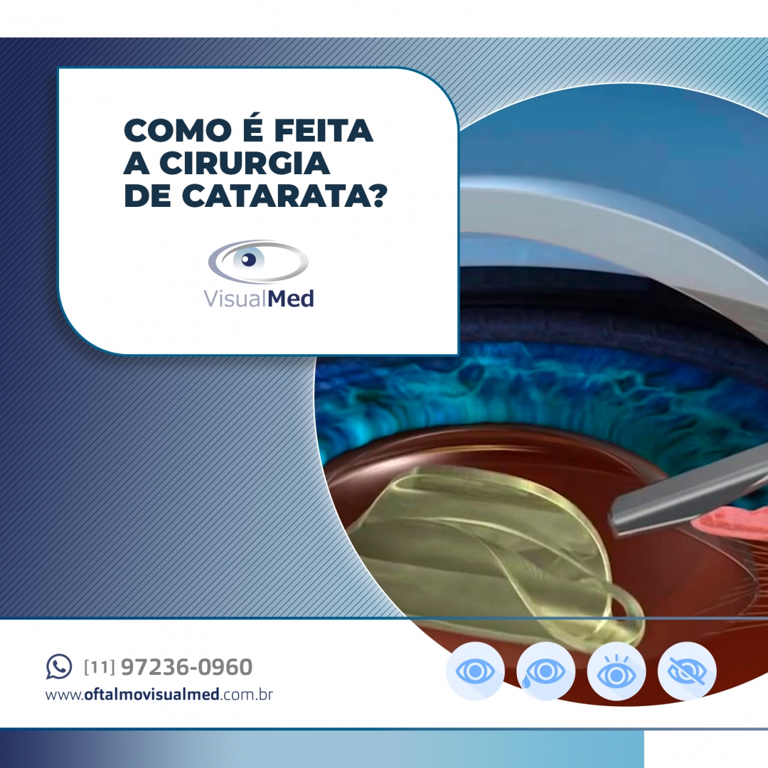 VisualMed - A cirurgia de catarata é relativamente simples...
