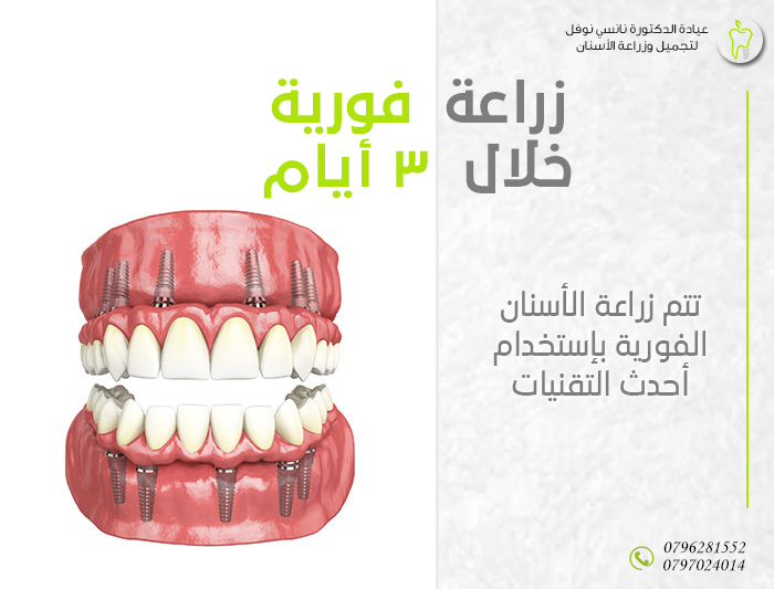زراعة الاسنان الفورية