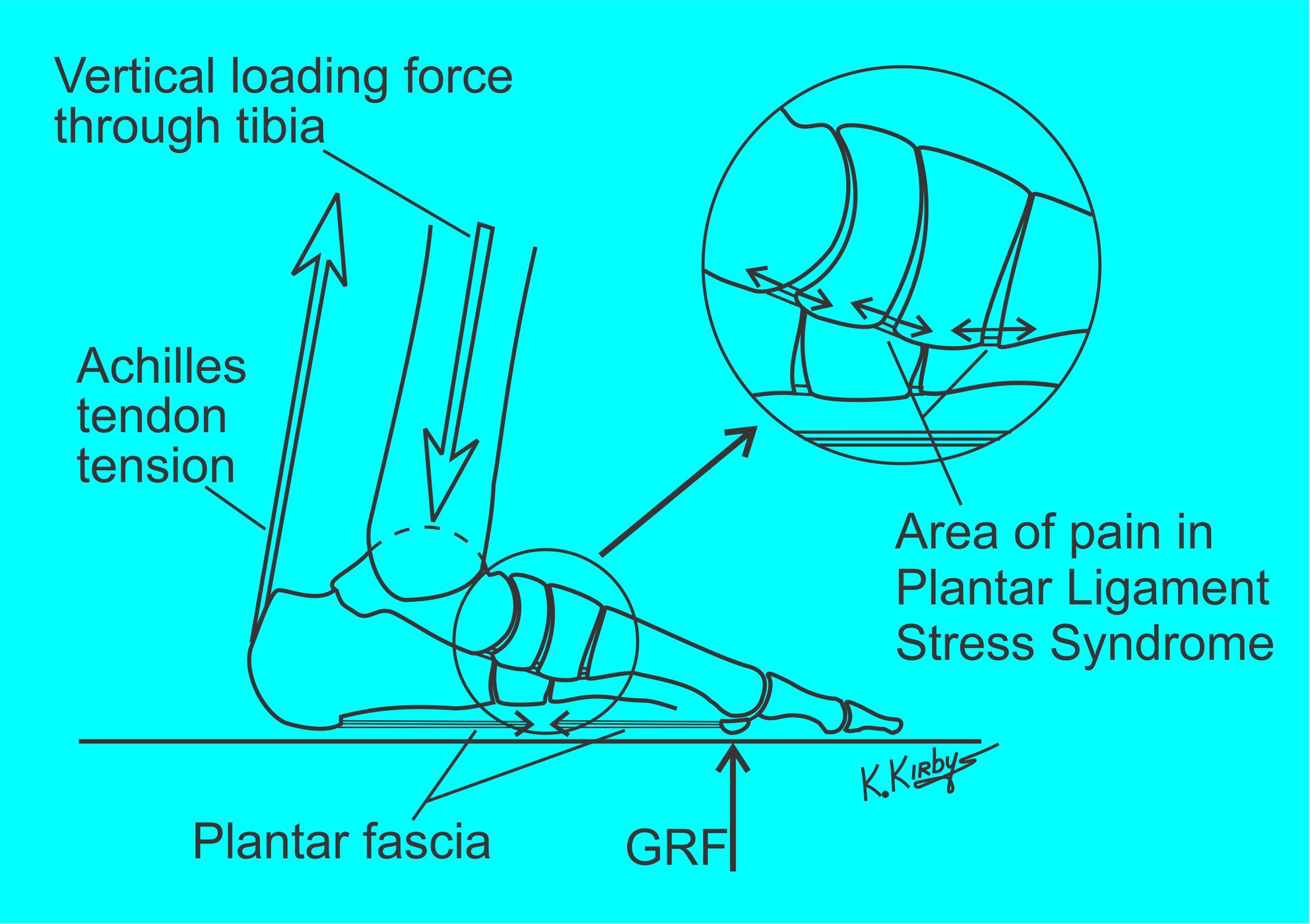 Kevin A. Kirby, DPM - Plantar Ligament Stress Syndrome A new pedal ...