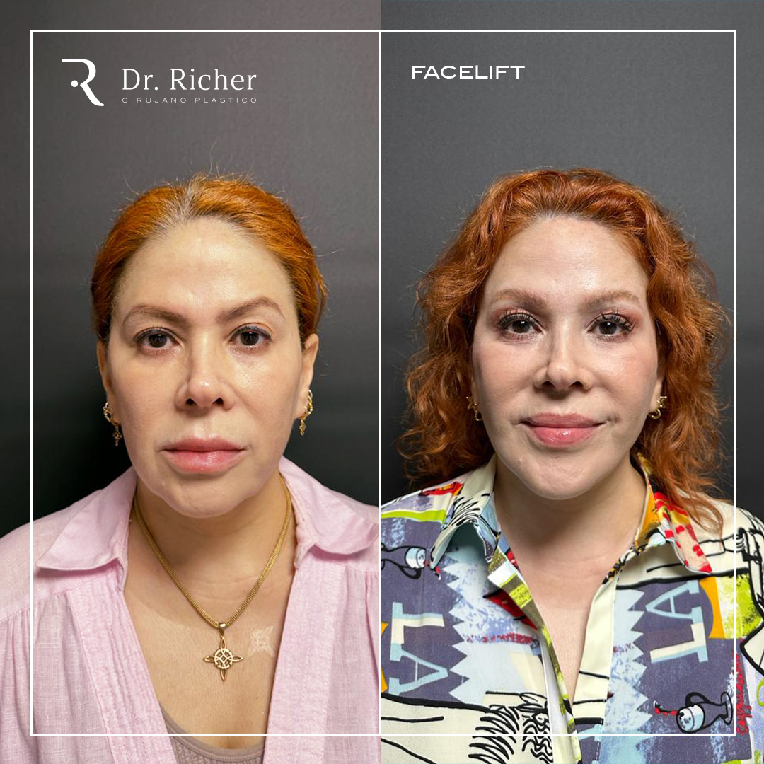 Seguimiento a 3 meses de... - Dr. Richer Cirujano Plástico