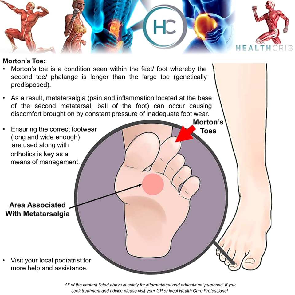 HealthCrib - THE FOOT: Morton’s toe and some of the signs... | Facebook
