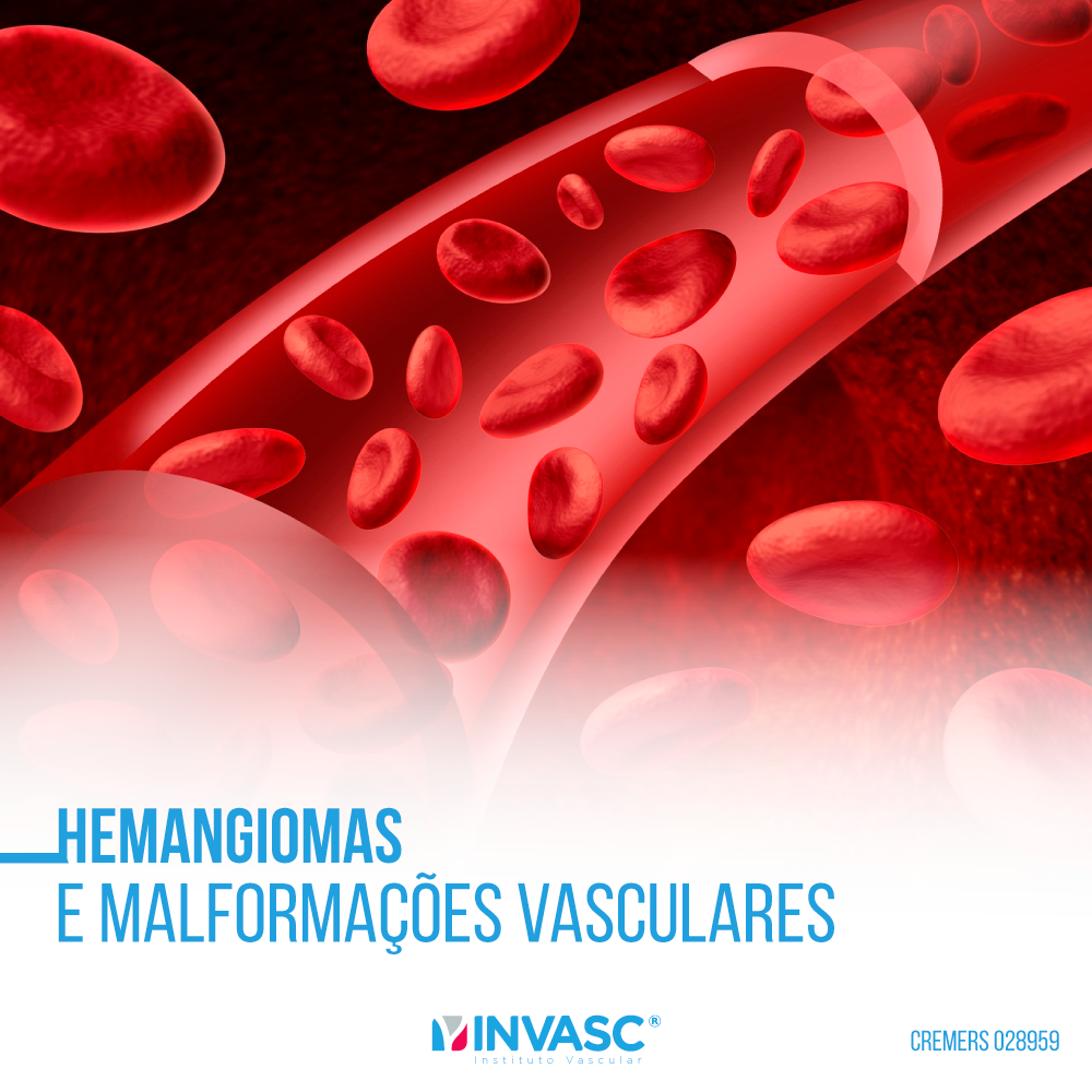 As malformações vasculares... - Invasc - Instituto Vascular