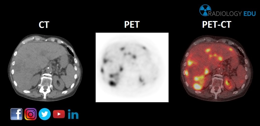 Radiology EDU - Positron emission tomography–computed tomography ...