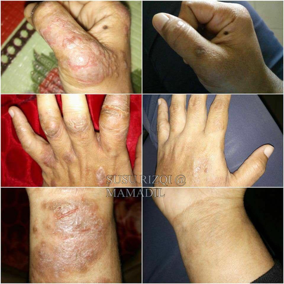 Mamadil Kekzaa Berbiji Biji Kesat Kasar Tengok Gambar Ni Pun Kekzaa Dah Tergaru Garu Macam Tangan Kekzaa Plak Yang Gatal Over Betul Macam Mana La Tuan Badan Tahan Diri Dari Menggaru Ni