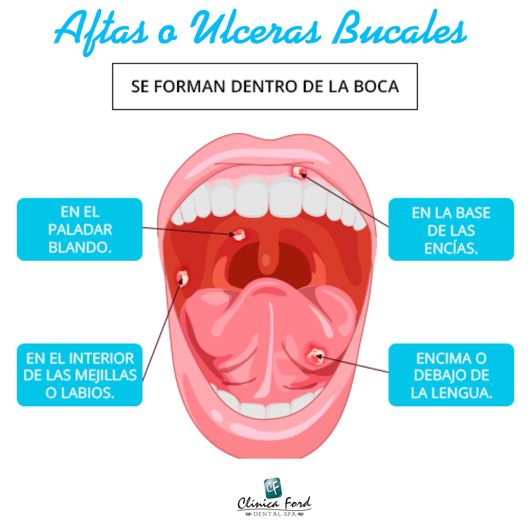 Clinica - Un #afta es una úlcera o llaga abierta y dolorosa en la #boca ...